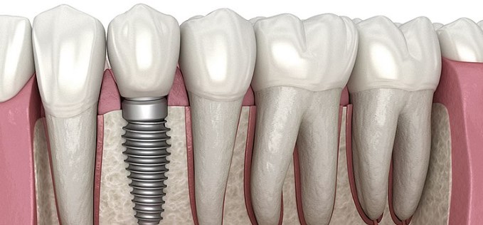 Dental Implants 101