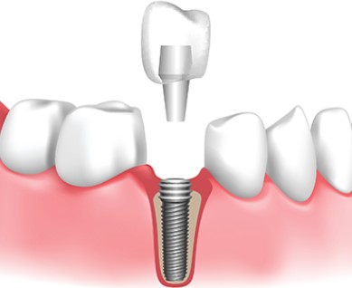 Dental Implants 101, tooth implants, oral implants, implant dentistry, permanent tooth replacement, dental restoration, osseointegrated implants, dental prosthesis, dental surgery, titanium implants, dental professionals, implantation procedure, dental health, tooth restoration, jawbone fusion, dental specialists, dental consultation, dental benefits, longlasting solution, dental technology, dental aesthetics, functional tooth replacement, dental experts, dental examination, dental candidacy